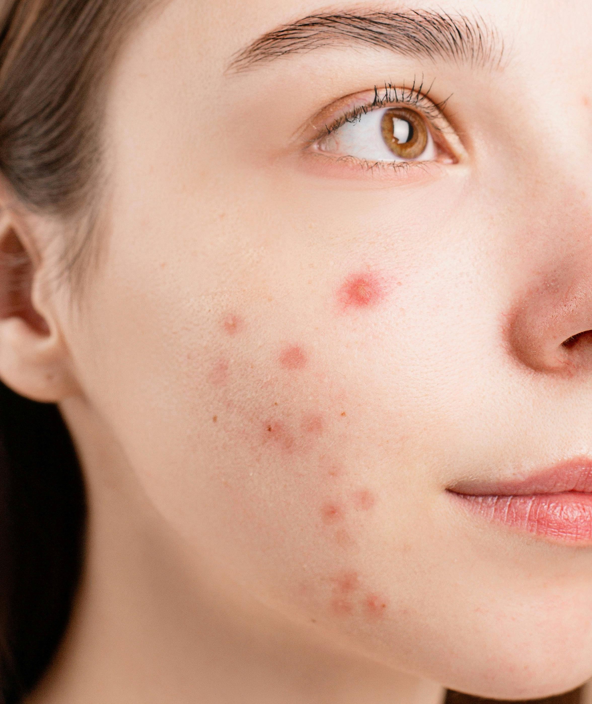 Hogyan Ápoljuk az Aknés,  Rosaceás, és Ekcémára Hajlamos Bőrt?